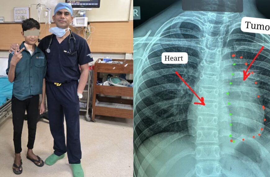 अंबेडकर अस्पताल ने बनाया वर्ल्ड रिकॉर्ड : डॉक्टरों ने 11 साल के बच्चे के दिल से चिपका दुर्लभ कैंसर निकाला, 40 से 60 वर्ष के लोगों में होता है यह ट्यूमर